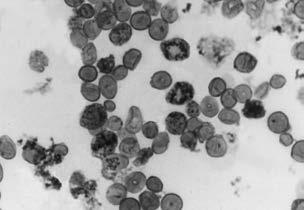 ΠΑΘΟΓΕΝΕΙΑ-ΔΙΑΓΝΩΣΗ-ΘΕΡΑΠΕΙΑ 47 β α γ β 0 ή β + : HbA ή HbA α2 + γ2 : HbF Περίσσεια αδέσμευτων α - αλυσίδων ΕΝΔΟΜΥΕΛΙΚΉ Έγκλειστα α4 στους ερυθροβλάστες Κατακρήμνιση α4 μορίων ΕΞΏΜΥΕΛΙΚΉ Έγκλειστα α4