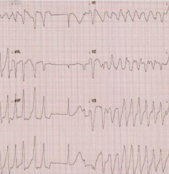 Torsade d points Tachycardia Aσθενής 83 ετών νοσηλεόμενη για λοίμωξη κατωτέρου αναπνευστικού στην Πνευμονολογική κλινική.