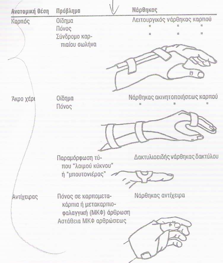 ΕΙΚ.24 Νάρθηκας ακινητοποιήσεως καρπού και καρποµετακάρπιας αρθρώσεως αντίχειρα.