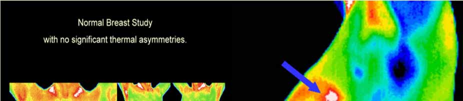 Υγεία Ψηφιακή υπέρυθρη θερμική απεικόνιση Απεικόνιση ιστών μέσω