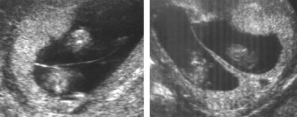 Εικόνα 2. Υπερηχογραφική απεικόνιση μονοχοριακής (αριστερά) και διχοριακής (δεξιά) διδύμου κυήσεως στις 12 εβδομάδες.