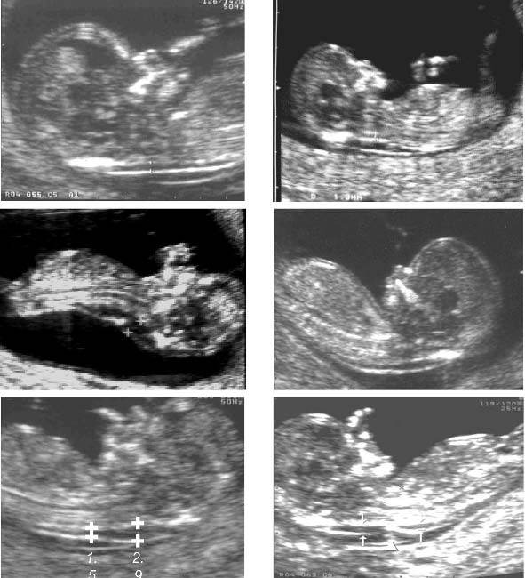 (a) (b) (c) (d) (e) (f) Εικόνα 8. Υπερηχογραφικές εικόνες εμβρύων 12 εβδομάδων. Σε όλες τις εικόνες υπάρχει καλή οβελιαία τομή του εμβρύου.