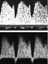 Εικόνα 6. Κυματομορφή του φλεβώδους πόρου στις 12 εβδομάδες με φυσιολογική μορφή (επάνω) και παθολογική (κάτω) με αναστροφή του κύματος a.