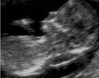 Εικόνα 1. Έμβρυο με υποδόρια συλλογή υγρού στον αυχένα. Εικόνα 2.