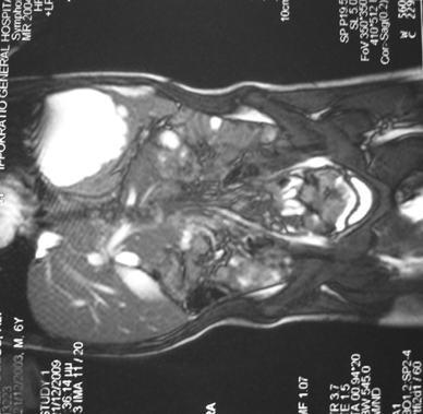 ΑΘΗΝΑ ΒΕΡΒΕΡΗ, ΔΗΜΗΤΡΙΟΣ ΖΑΦΕΙΡΙΟΥ, ΜΑΡΙΝΑ ΟΙΚΟΝΟΜΟΥ Όσον αφορά το μόρφωμα στο σπλήνα (που τυχαία είχε αναδείξει η CT θώρακα), διενεργήθηκε υπερηχογράφημα και MRI κοιλίας (εικόνα 2), που έδειξαν