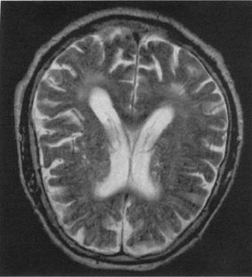 Τ 1 αξονική MRI εγκεφάλου ασθενούς με ισχαιμικά φαινόμενα και διάγνωση οξείου εμφράγματος Τ 2 αξονική MRI εγκεφάλου