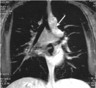 αναπαραγωγή που δείχνει σοβαρή στένωση στην αρτηρία) MRI του στέρνου ασθενούς με ένδειξη για καρκίνωμα στο επάνω