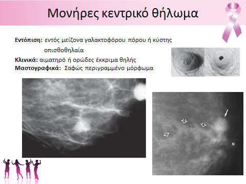 μικροεπασβεστώσεων (BI-RADS 4) και χρήζουν βιοψίας.