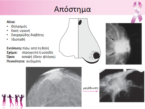 14 Ακτινολογικά Χρονικά, 1, 4 Το απόστημα εμφανίζεται συνήθως οπισθοθη λαία και έχει συχνά κακοήθη μαστογραφική απει κόνιση με ασαφή όρια και αυξημένη