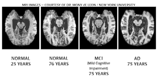 πιθανής νόσου Alzheimer s. 1. Ιστορικό 2.