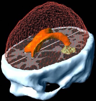 (longitudinal/multiscale) γελεηηθέο πιεξνθνξίεο modeling of brain tumor evolution In vivo cellular imaging of brain