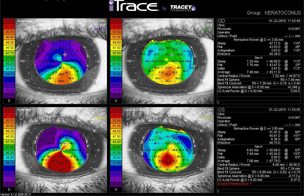Η τοπογραφία του κερατοειδούς είναι η εξέταση εκλογής για τη διάγνωση και την παρακολούθηση