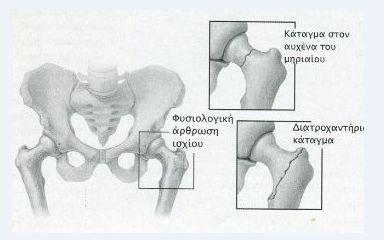 Σα διατροχαντήρια κατάγματα παρουσιάζονται στην περιοχή ενδιάμεσα των δυο