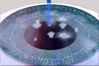 excimer laser και plume evacuation φωτοδιάσπαση