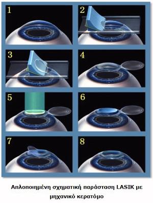 LASIK Δημιουργία κρημνού με μικροκερατόμο (μηχανικό ή laser)