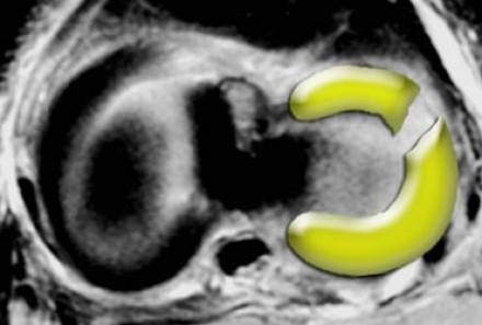 Empty meniscus sign Σχηματική απεικόνιση μιας πλήρους