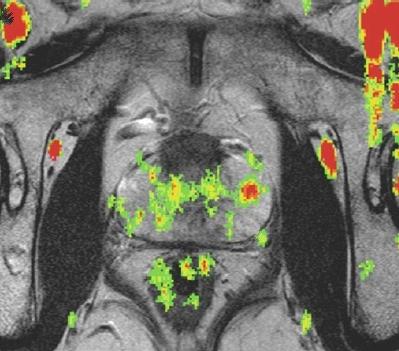 ΔΥΝΑΜΙΚΗ ΣΚΙΑΓΡΑΦΙΚΗ ΜΕΛΕΤΗ (DCE-MRI) ΔΥΝΑΜΙΚΗ ΣΚΙΑΓΡΑΦΙΚΗ ΜΕΛΕΤΗ (DCE-MRI) Δυναμική σκιαγραφική μελέτη (DCE-MRI) με την χρήση καμπυλών ή