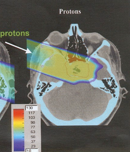 Η έρευνα στο CERN και οι ιατρικές εφαρμογές 451 Τη δεκαετία του 1960 τα νετρόνια μπήκαν στο παιχνίδι της ραδιοθεραπείας.