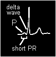 The Delta Wave The presence of a delta wave on the ECG suggests conduction from A to V is via an accessory pathway.