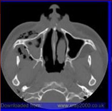 120 ma 180 facial bones 60 sinuses (low dose) Rotation Time 0.5sec Raw Slice Thickness 16x0.
