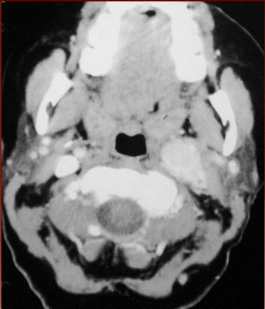 woman with hoarseness and right recurrent laryngeal nerve paralysis who underwent axial contrast-enhanced CT.