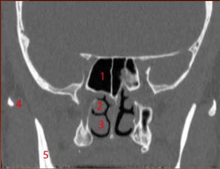 1, Maxillary sinus. 2, pterygoid process. 3, Rhinopharynx. 4, Mandible. 5, Atlas: anterior arch. 6, Odontoid process (dens) of the axis. 1, Anterior clinoid process.