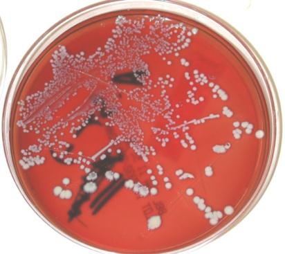Διάγνωση - Καλλιέργεια ούρων συνέχεια Κριτήρια σημαντικής βακτηριουρίας: 10 5 cfu / ml (MSU) Κλασσικά το gold standard σημαντικής βακτηριουρίας Ευαισθησία: <80% Ειδικότητα: >95% Σε γυναίκες με