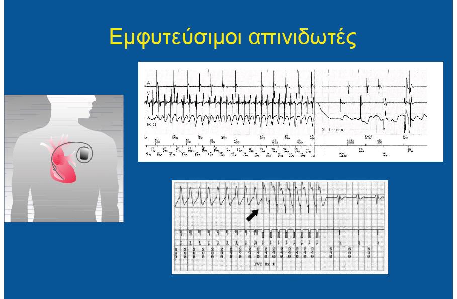 Συσκευή ICD Aνιχνεύoυν επεισόδια Κoιλιακής Ταχυκαρδίας ή Κoιλιακής Μαρμαρυγής τα