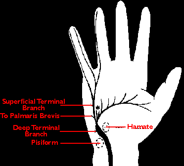Τα συμπώματα μιας ωλένιας νευρίτιδας περιλαμβάνουν τα αισθητικά ενοχλήματα στα δύο τελευταία δάχτυλα και αδυναμία κυρίως στην κάμψη