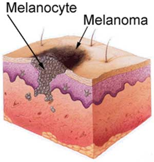 Τί είναι το μελάνωμα Το μελάνωμα είναι μια παράλογη αναπαραγωγή των μελανοκυττάρων.