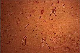 Yersinia enterocolitica Μεσεντέρια αδενίτιδα ΔΔ από σκωληκοειδίτιδα Οζώδες ερύθημα, αρθρίτις Μικροβιαιμία σε
