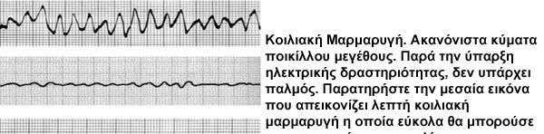 Πρακτικά, οποιαδήποτε παθολογία της καρδιάς μπορεί να οδηγήσει σε αιφνίδιο θάνατο με μια ποικιλία μηχανισμών, που όλοι όμως καταλήγουν σε θανατηφόρες αρρυθμίες.