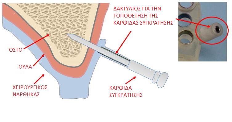 ΜΕΡΗ ΧΕΙΡΟΥΡΓΙΚΟΥ ΝΑΡΘΗΚΑ ΕΜΦΥΤΕΥΜΑΤΩΝ ΜΕΡΗ ΤΟΥ ΧΕΙΡΟΥΡΓΙΚΟΥ ΝΑΡΘΗΚΑ ΕΜΦΥΤΕΥΜΑΤΩΝ Anchor Pin/Anchor Drill Περιγραφή Διασφαλίζει ότι ο χειρουργικός νάρθηκας είναι σταθερά ακινητοποιημένος στη