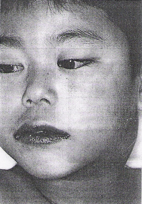 ΕΙΚ. 19 Χαρακτηριστικό προσωπείο στη νόσο του Kawasaki. ΕΙΚ. 20 Απολέπιση δέρµατος µετά την αποδροµή του εξανθήµατος σε παιδιά ηλικίας 6 και 8 ετών µε νόσο του Kawasaki.