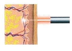 Radiofrequency ablation Laser ablation 1. 2. 3.