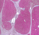 NAFLD Στεατοηπατίτιδα (ΣΗ) 17-40% ALD 2-30%
