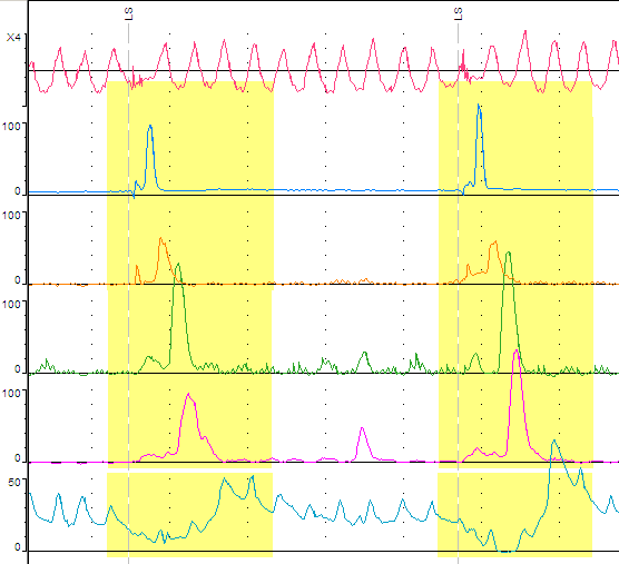 ζπζπάζεηο ζην ζώκα & ράιαζε ηνπ ΚΟΣ Γξακκσηέο κπηθέο ίλεο ΑΟΣ Ζώλε κεηάπησζεο Σώκα Λείεο