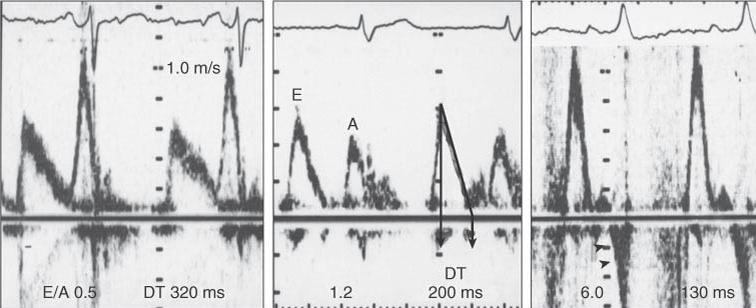 5 DT: 160-220 ms E/A: 2 DT: < 160 ms Πρόβλεψη επίδρασης ενδοτικότητας ΑΚ μετά την ταχεία πλήρωση Προβληματικές σε αυξημένη ΚΣ, ΚΜ, Κ-κ αποκλεισμό, βηματοδότηση,