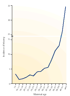 Τρισωμία 18 (σύνδρομο