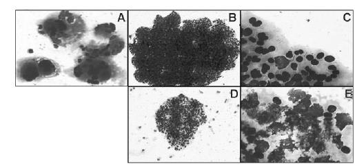 Βιολογικά χαρακτηριστικά Ανάπτυξη αποικιών in vitro RARS-T vs ET A: Σχηματισμός αποικιών μεγακαρυοκυτταρικής σειράς απουσία αυξητικών παραγόντων στην Ιδιοπαθή θρομβοκυττάρωση