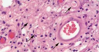 λεµφοκύτταρα ηωσινόφιλα και ουδετερόφιλα