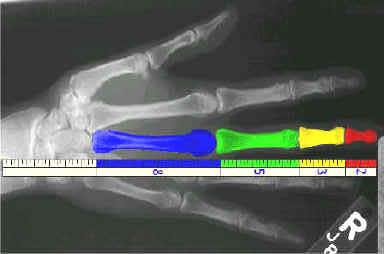 Τα εκατοστά των οστών του χεριού μας αντιστοιχούν στους όρους της ακολουθίας.