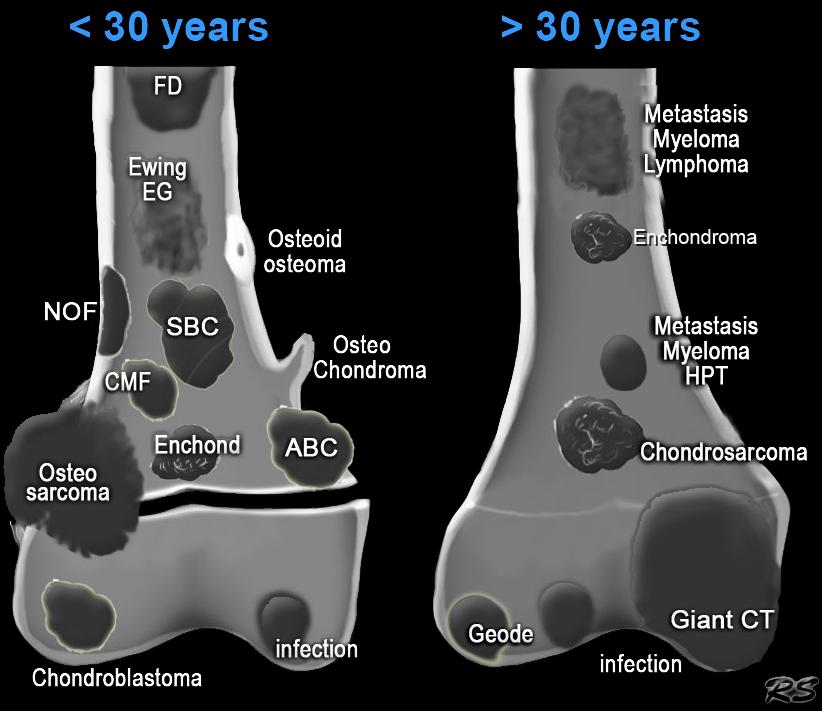 οστική κύστη HPT: brown tumor υπερπαραθυρεοειδισμού