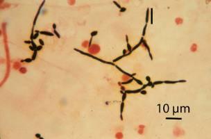 Fusarium, Scedosporium) υφές ευρείες και ακανόνιστες υφές διαμέτρου 4-6μm χωρίς διαφραγμάτα με παράλληλα και χωρίς