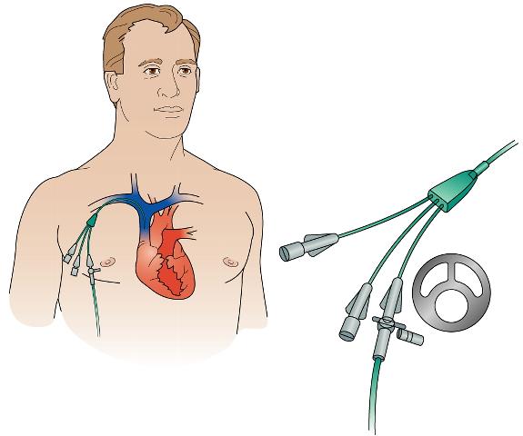 Κεντρικές φλεβικές γραμμές - Ορισμός Συσκευή φλεβικής αγγειακής προσπέλασης που καταλήγει κοντά ή εγγύς στην καρδιά ή σε μεγάλη φλέβα