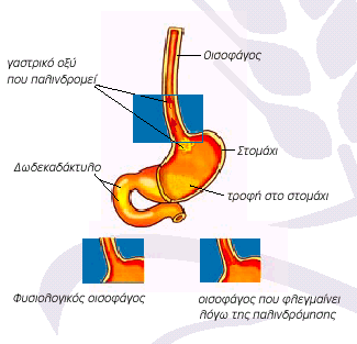 ΓΑΣΤΡΟ-ΟΙΣΟΦΑΓΙΚΗ ΠΑΛΙΝΔΡΟΜΙΚΗ ΝΟΣΟΣ Αίτιο Χαλάρωση σφιγκτήρα κατώτερου οισοφάγου Συχνή