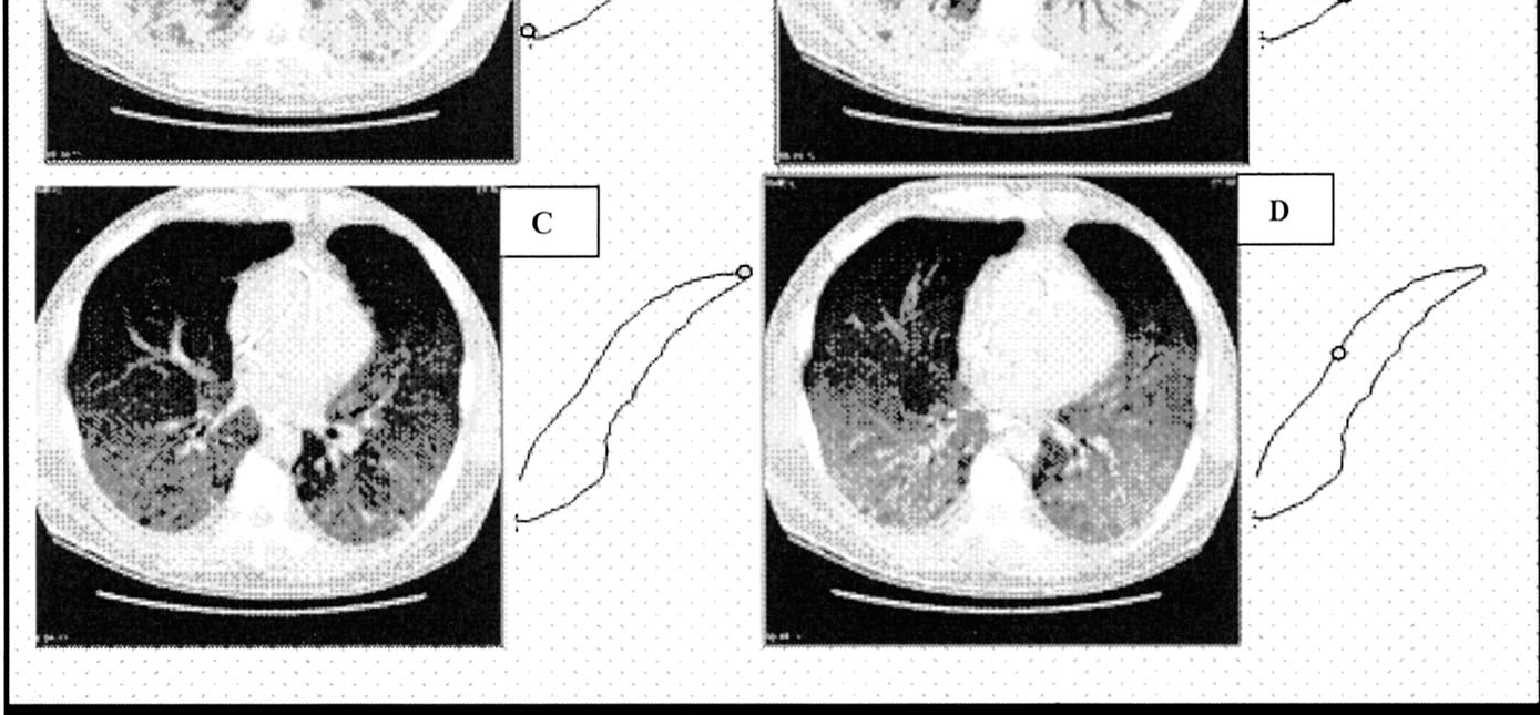 Lung