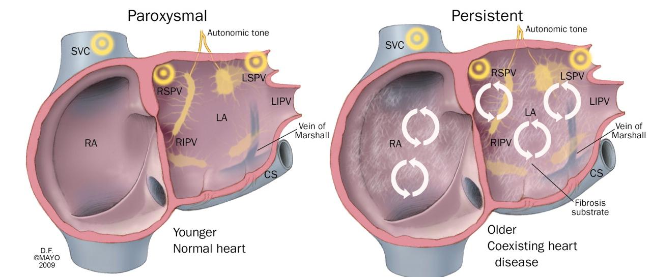 Υπερ Κατά Παροξυσμική Κολπική Μαρμαρυγή «Ιδιοπαθής» Κολπική Μαρμαρυγή Συμπτωματική νόσος Αδυναμία ασφαλούς μακροχρόνιας λήψης