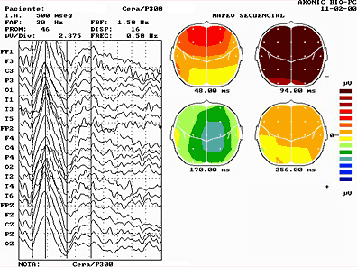 evoked potentials AEPs) 2.