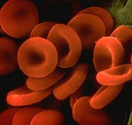 Συμπτώματα - Διάγνωση Η αιματουρία αποτελεί το κυρίαρχο σύμπτωμα μπορεί να είναι μακροσκοπική η μικροσκοπική Η βαρύτητα της